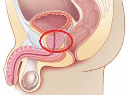 Krónikus urethritis és prosztatitis kezelése Fájdalom a rectum a prosztata
